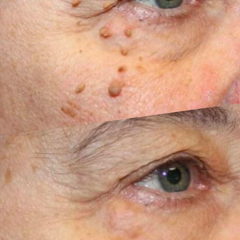 15-Minute Skin-Tag Removal Session 15-Minute Skin-Tag Removal Session